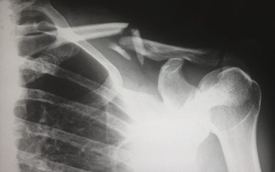 xray image of shoulder